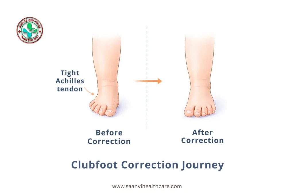 "clubfoot treatment in babies showing foot correction process