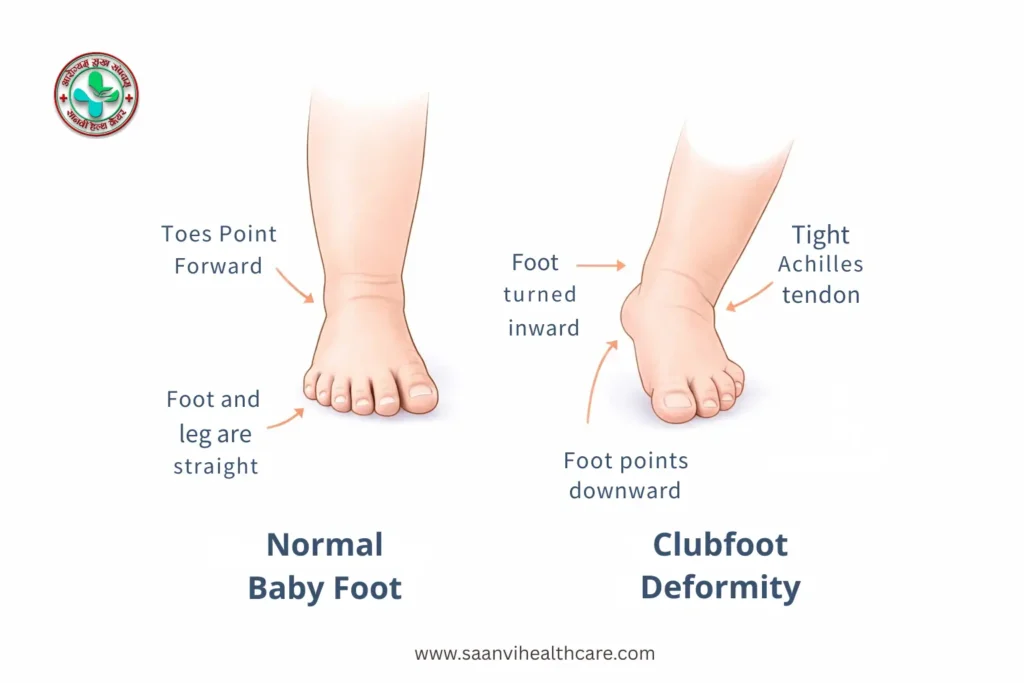 Congenital clubfoot deformity before treatment in infant