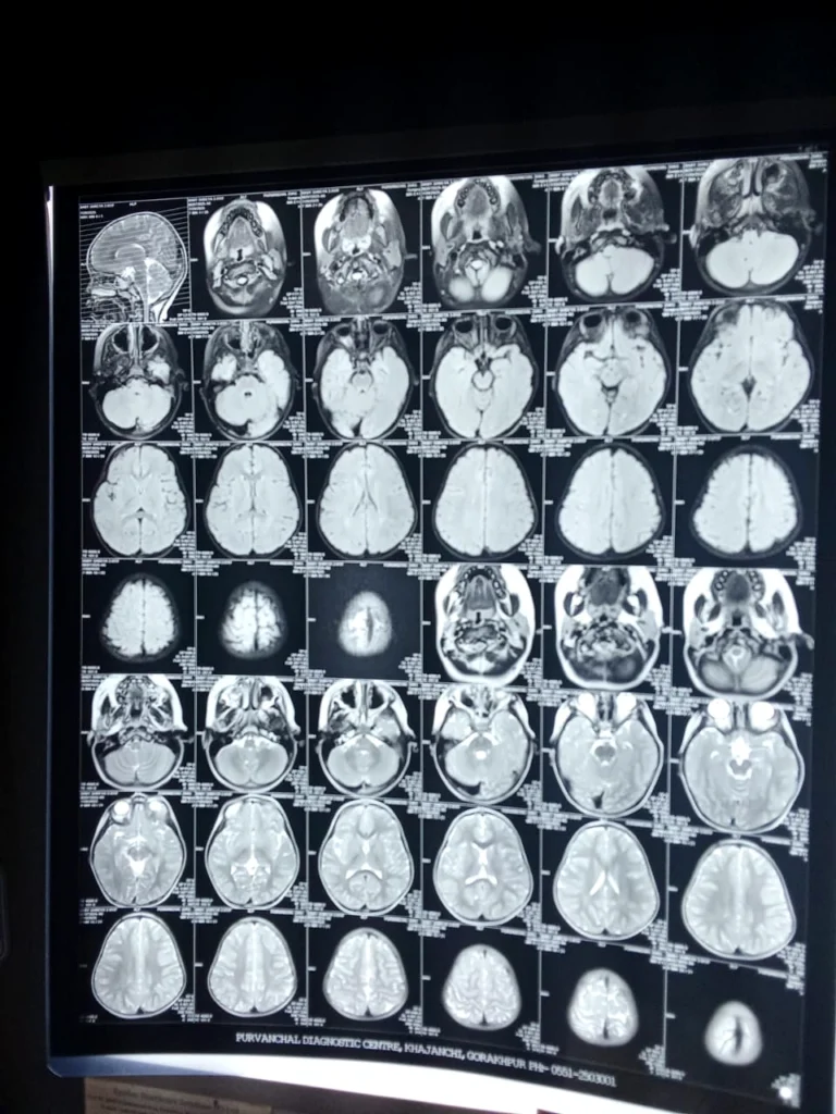 MRI scan used for diagnostic evaluation at Saanvi Healthcare in Gorakhpur